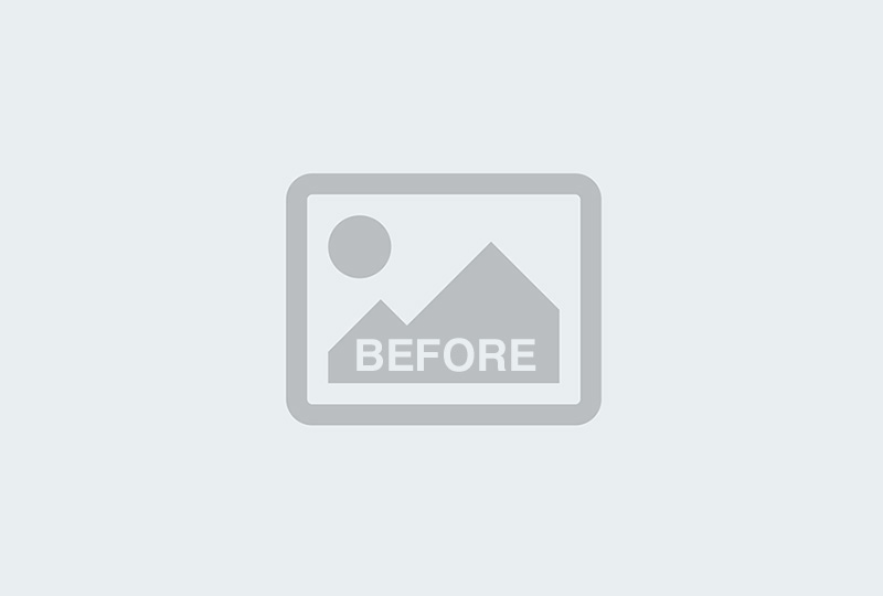Before Image: Liposuction Tummy - 