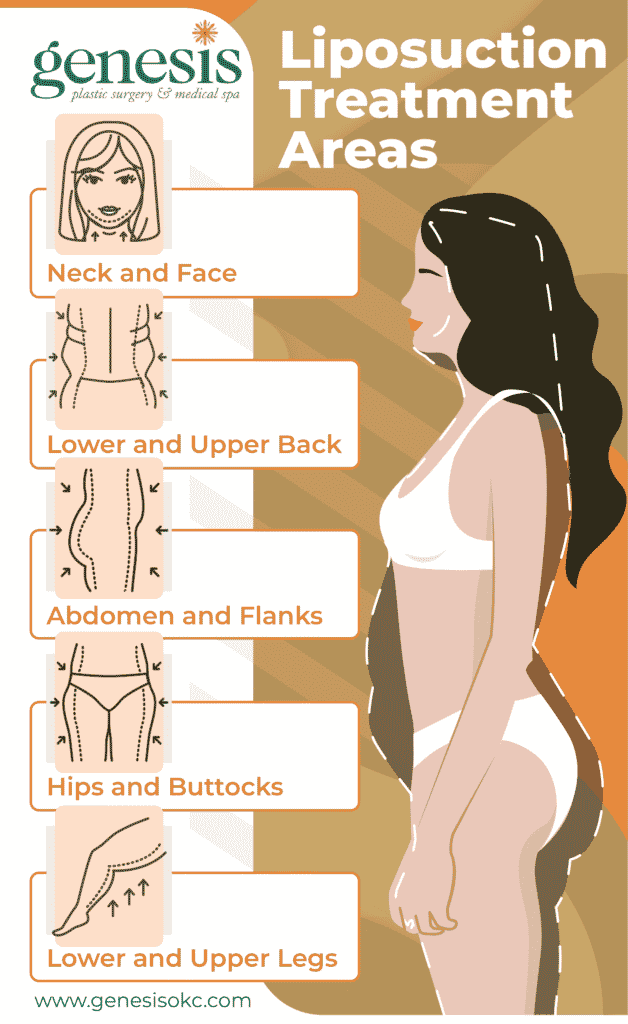 Liposuction treatment areas 11