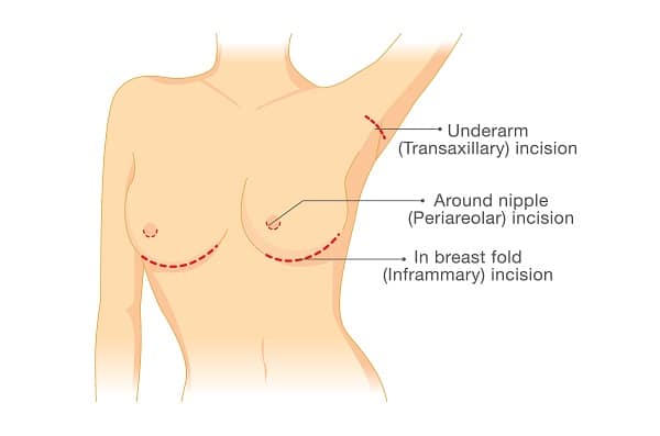 Breast Augmentation Incision Options