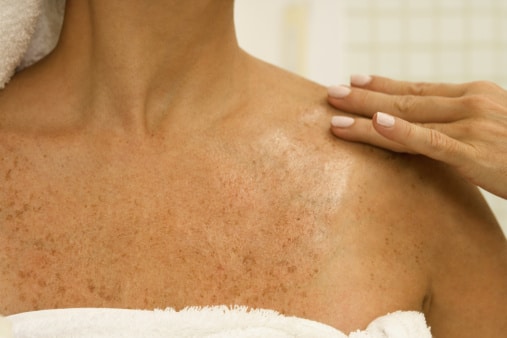 Fraxel treatments by Dr Panchal at Genesis OKC in Edmond 2