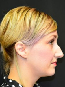 Before Image: Nose Reshaping