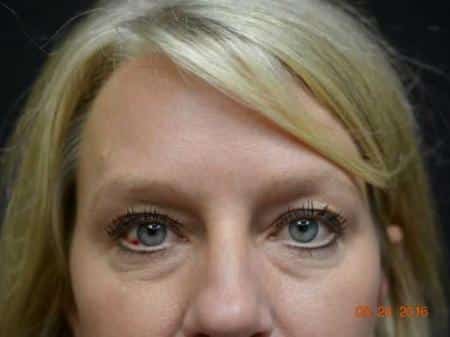 Before Image: Eyelid Surgery - front