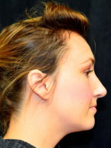 After Image: Nose Reshaping