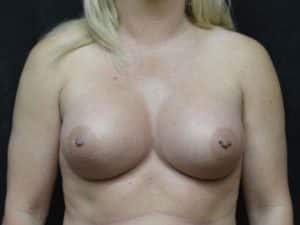 Breast Enlargement