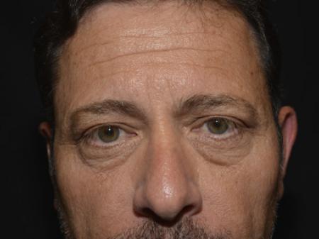 Before Image: Eyelid Surgery - front
