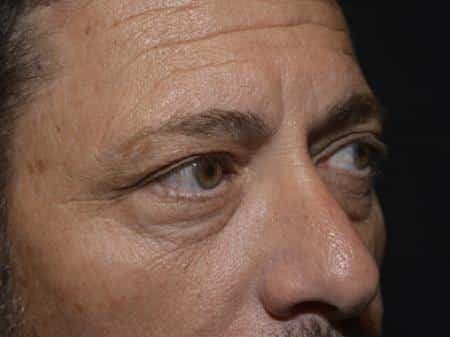 Before Image: Eyelid Surgery - right-front-oblique