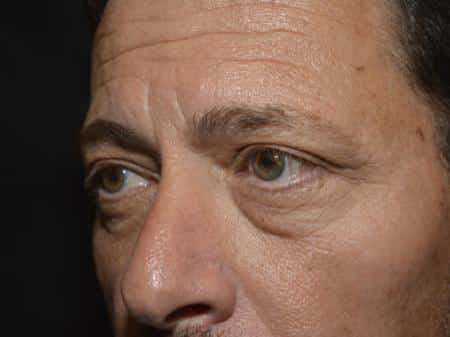 Before Image: Eyelid Surgery - left-front-oblique