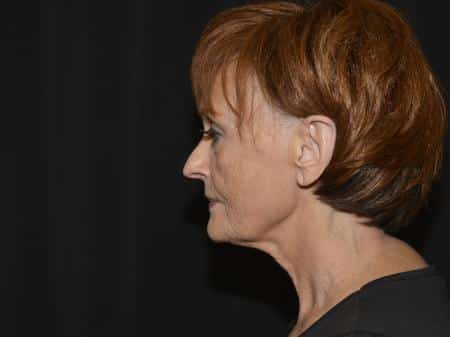 Before Image: Naturale Facelift - left-side