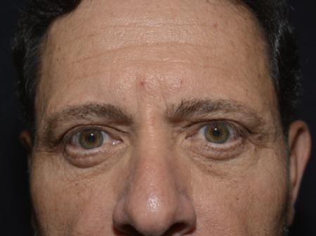 After Image: Eyelid Surgery - front