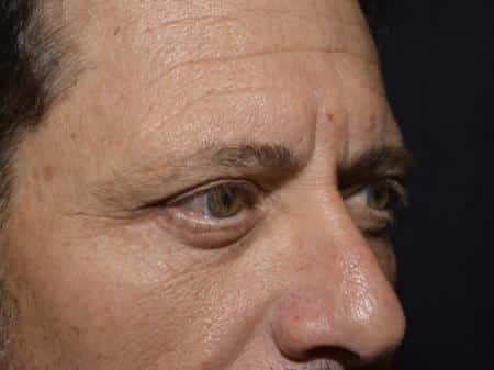 After Image: Eyelid Surgery - right-front-oblique