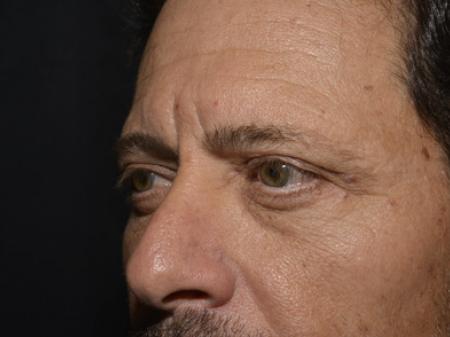 After Image: Eyelid Surgery - left-front-oblique