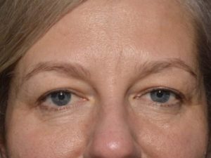 Eyelid Surgery