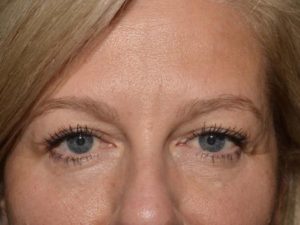 Eyelid Surgery