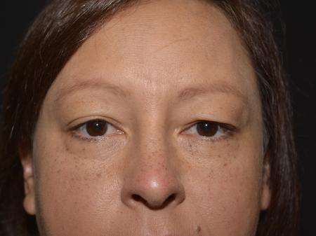 Before Image: Eyelid Surgery - front