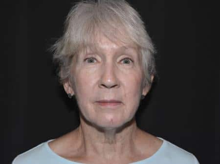 Before Image: Naturale Facelift - front