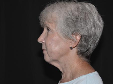 Before Image: Naturale Facelift - left-side