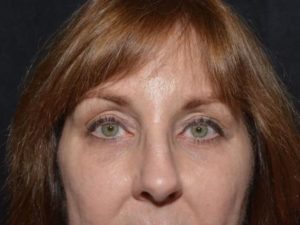 Eyelid Surgery