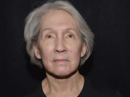 After Image: Naturale Facelift - front