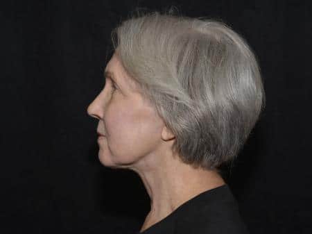After Image: Naturale Facelift - left-side