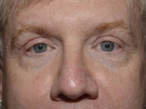 Eyelid Surgery