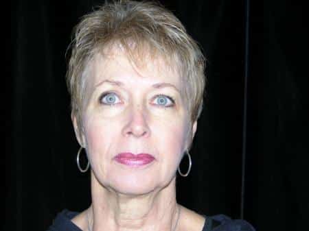 Before Image: Naturale Facelift - front