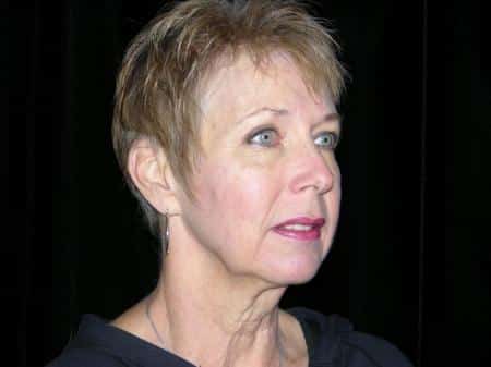 Before Image: Naturale Facelift - 