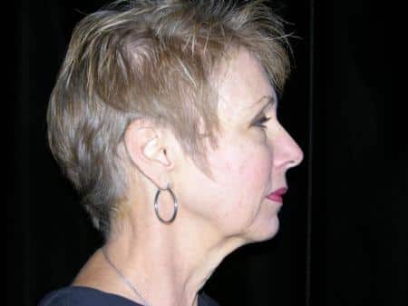 Before Image: Naturale Facelift - right-side