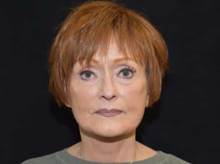 After Image: Naturale Facelift - front
