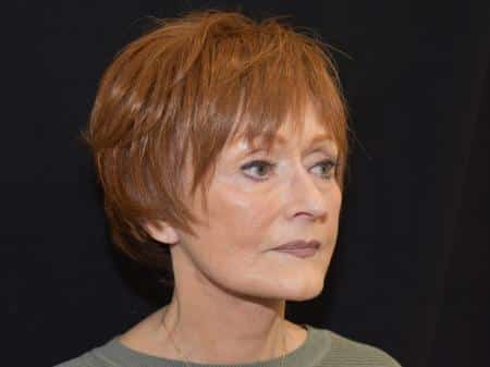 After Image: Naturale Facelift - right-front-oblique
