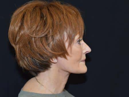After Image: Naturale Facelift - right-side