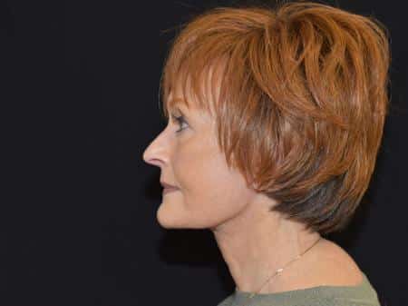 After Image: Naturale Facelift - left-side
