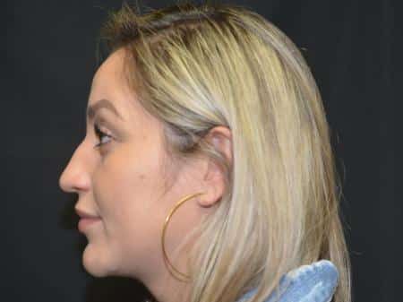 Before Image: Nose Reshaping - 