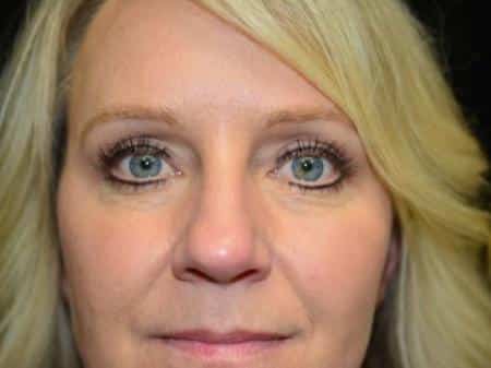 After Image: Eyelid Surgery - front
