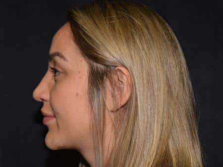 After Image: Nose Reshaping - 