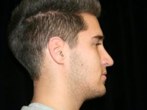 After Image: Nose Reshaping