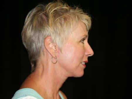 After Image: Naturale Facelift - right-side