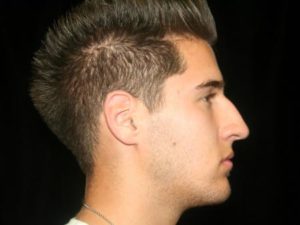Before Image: Nose Reshaping