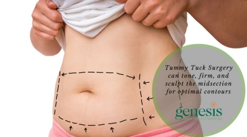 OKC Tummy Tuck Surgery