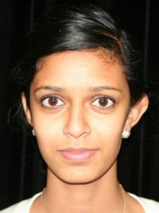 Before Image: Ear Correction