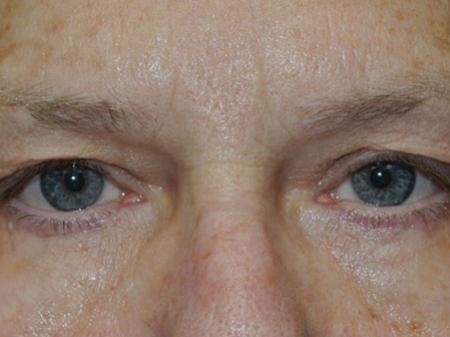 After Image: Eyelid Surgery - front