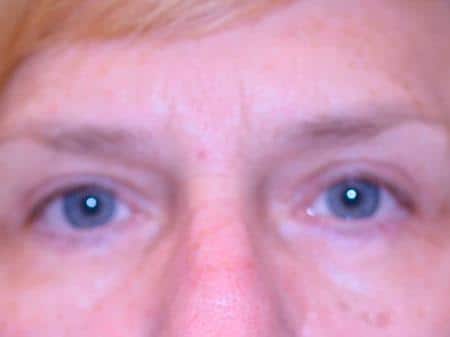 Before Image: Eyelid Surgery - front