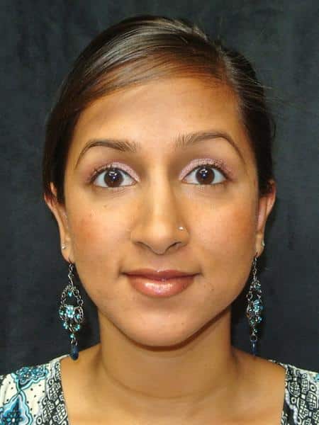 After Image: Nose Reshaping - front