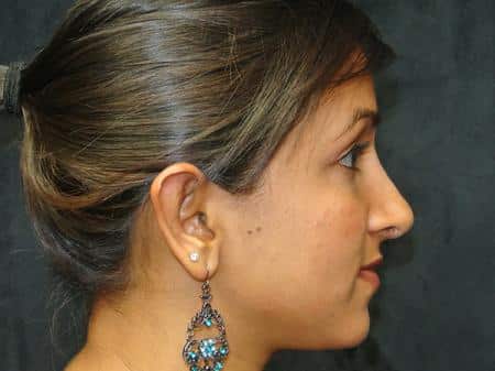 After Image: Nose Reshaping - right-side