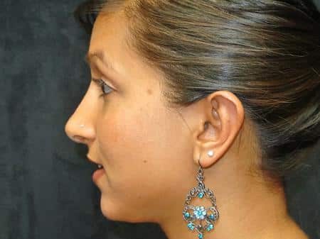 After Image: Nose Reshaping - left-side