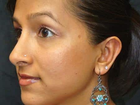 After Image: Nose Reshaping - left-front-oblique