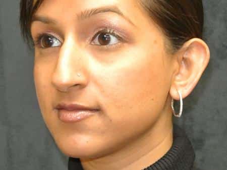 Before Image: Nose Reshaping - left-front-oblique