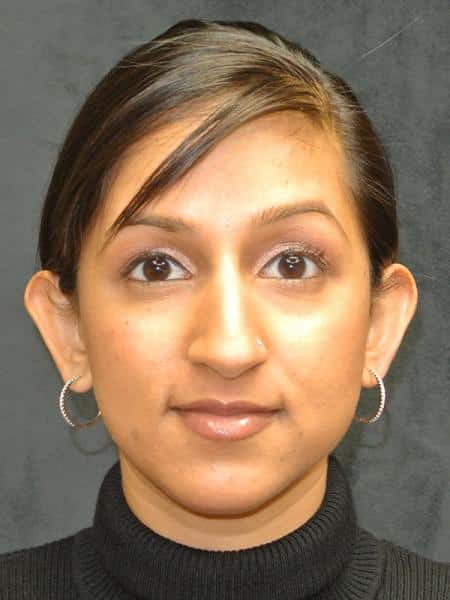Before Image: Nose Reshaping - front