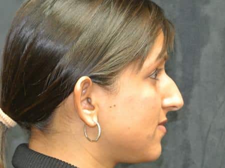 Before Image: Nose Reshaping - right-side