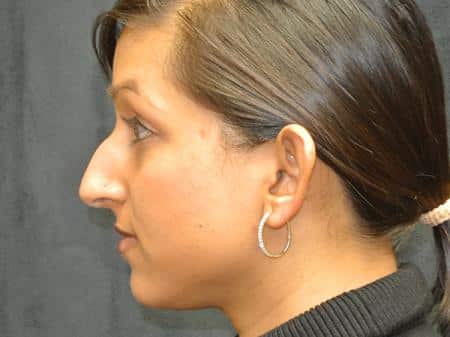 Before Image: Nose Reshaping - left-side