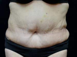 After Image: Body Contouring After Weight Loss Surgery